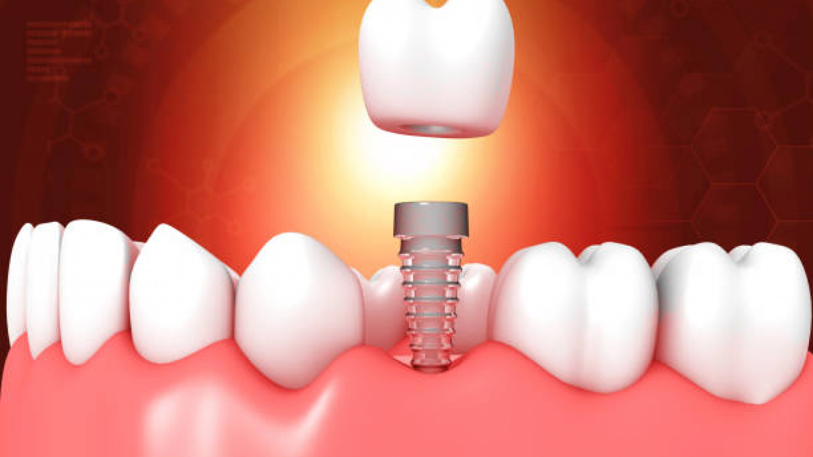 Dental implant  medical concept. 3d illustration