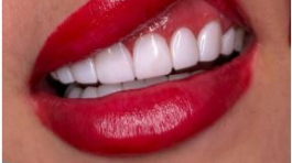 کامپوزیت در ماهانا کلینیک