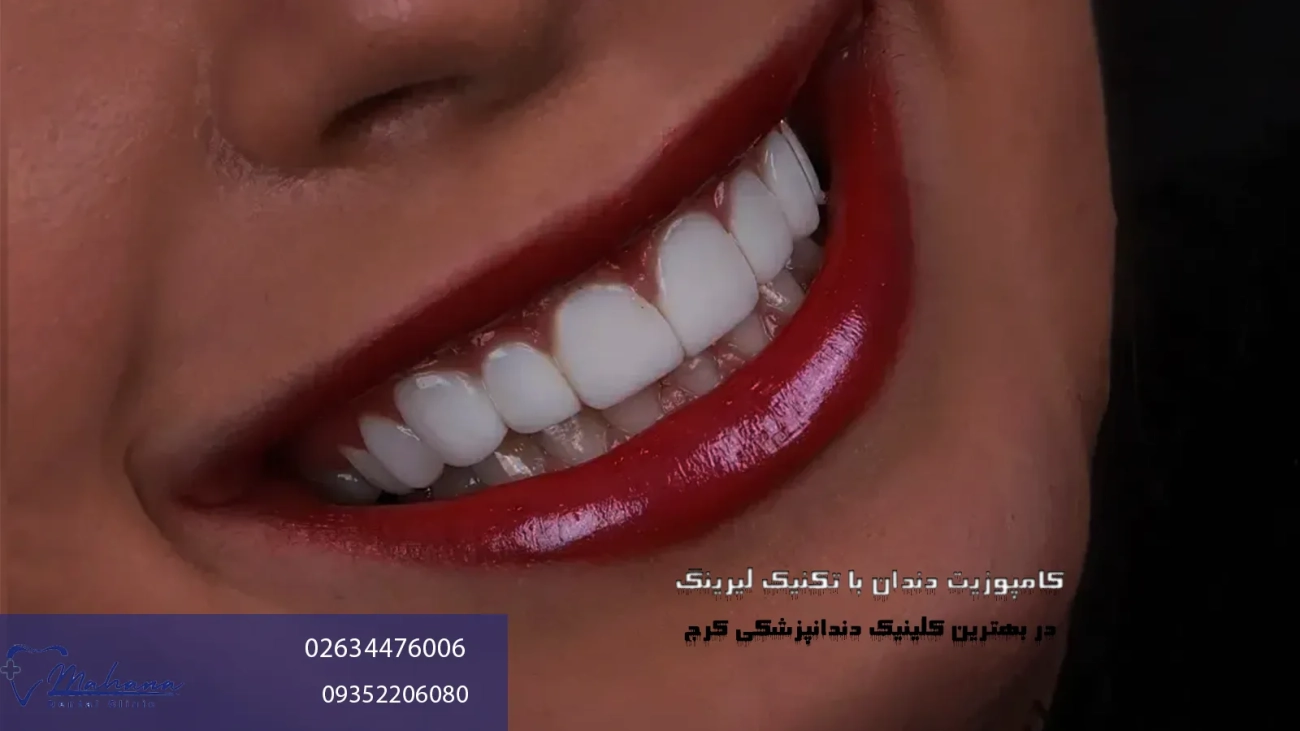 کامپوزیت لیرینگ در کرج