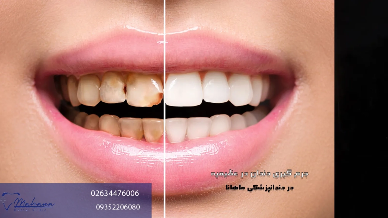 جرم گیری دندان در عظیمیه