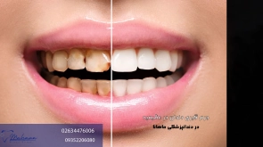 جرم گیری دندان در عظیمیه