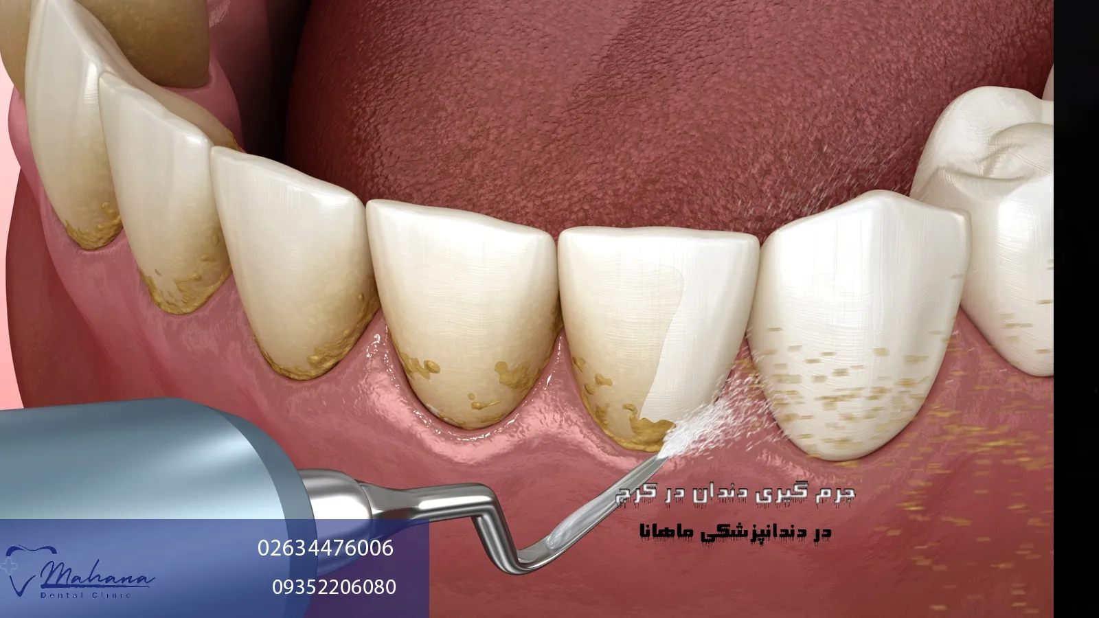 جرم گیری دندان در کرج