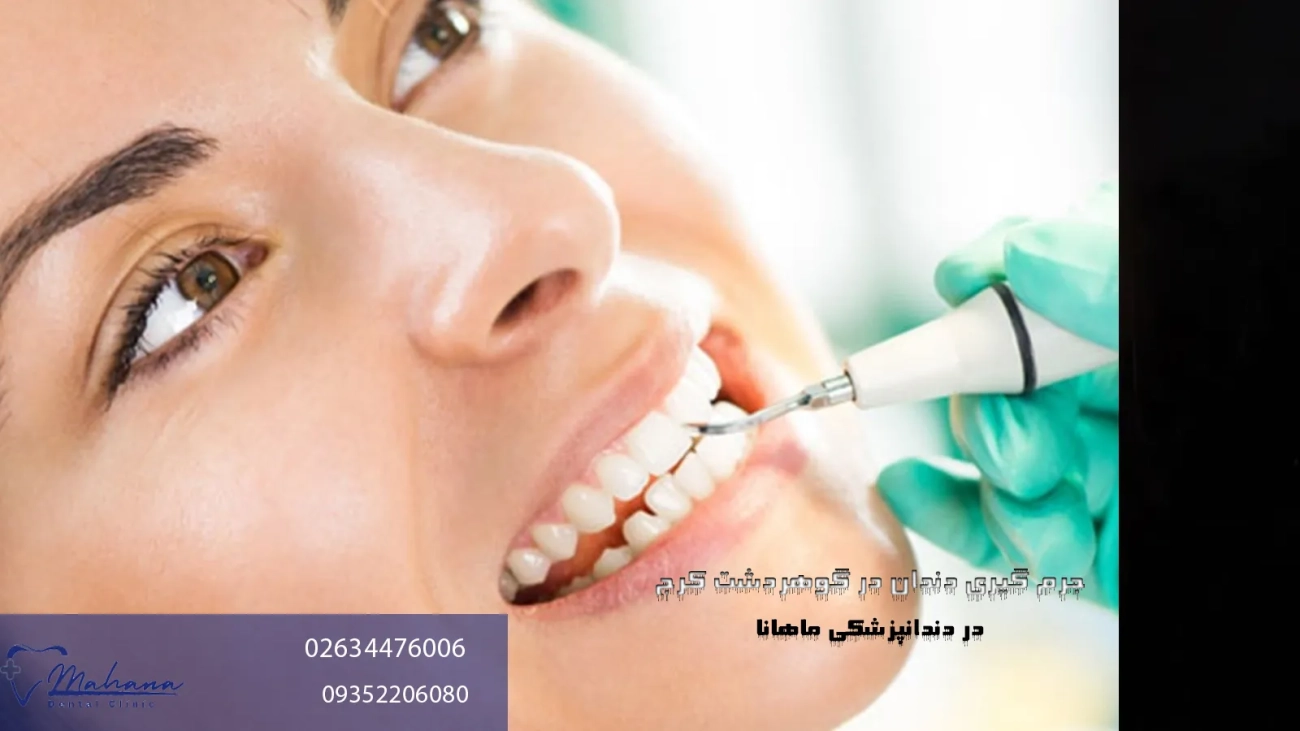 جرم گیری دندان در گوهردشت کرج