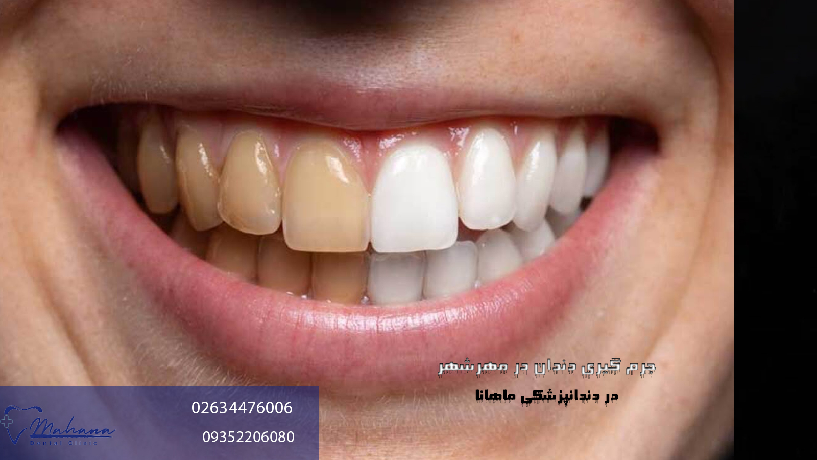 جرم گیری دندان در مهرشهر کرج