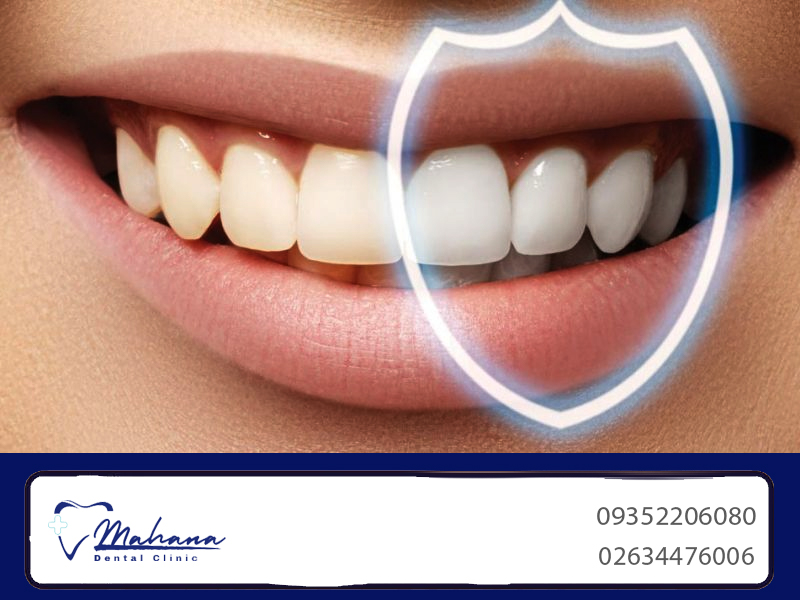 جرم گیری دندان در مهرشهر