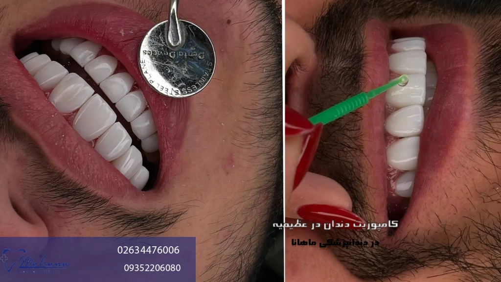 کامپوزیت دندان در عظیمیه کرج