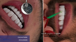 کامپوزیت دندان در عظیمیه کرج