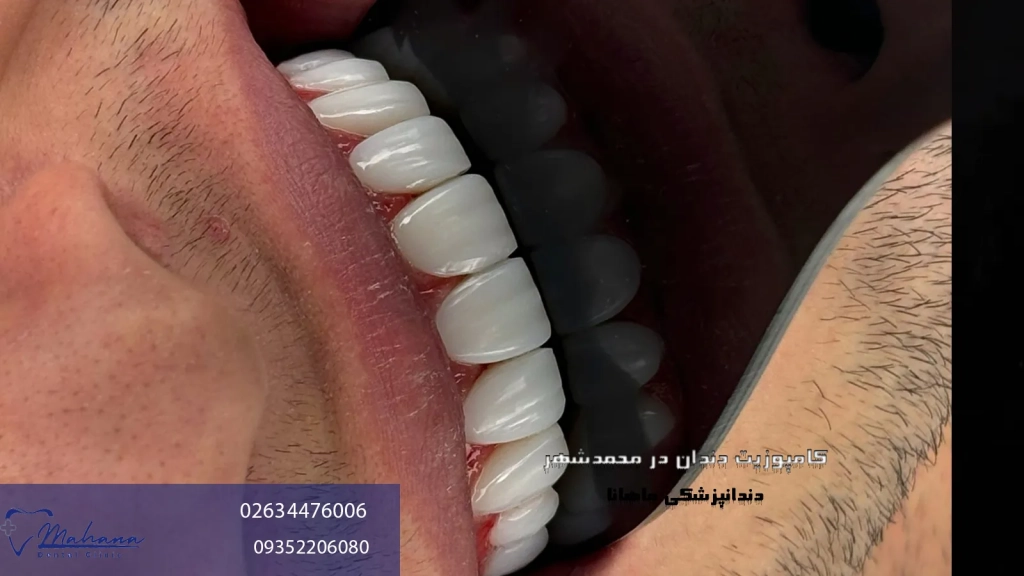 کامپوزیت دندان در محمد شهر