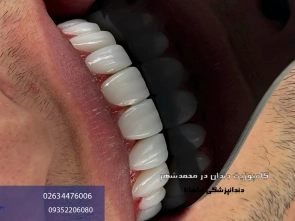 کامپوزیت دندان در محمد شهر