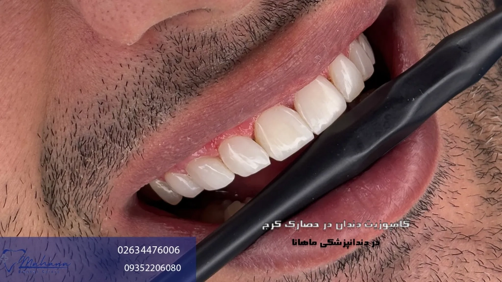 خدمات کامپوزیت دندان در حصارک کرج