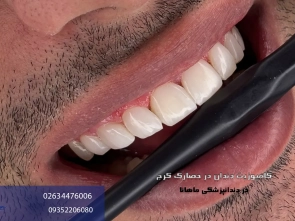 خدمات کامپوزیت دندان در حصارک کرج