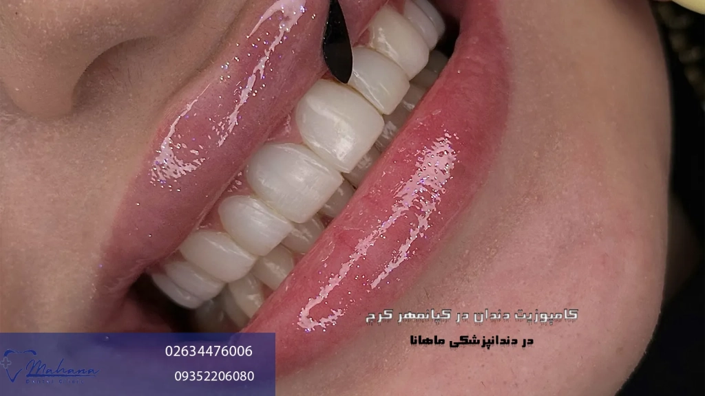 کامپوزیت دندان در کیانمهر کرج