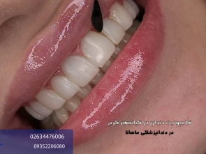 کامپوزیت دندان در کیانمهر کرج