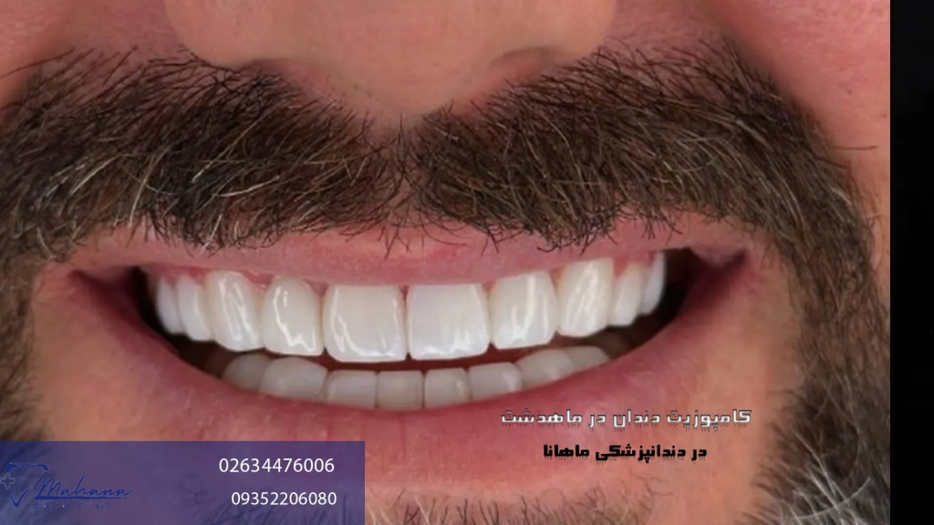 کامپوزیت دندان در ماهدشت کرج