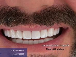 کامپوزیت دندان در ماهدشت کرج