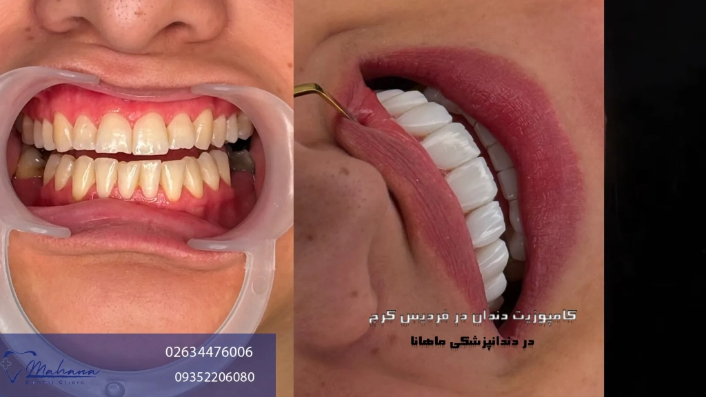 کامپوزیت دندان در فردیس کرج