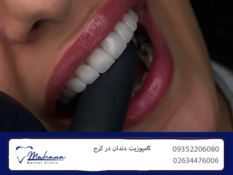 کامپوزیت دندان در کرج