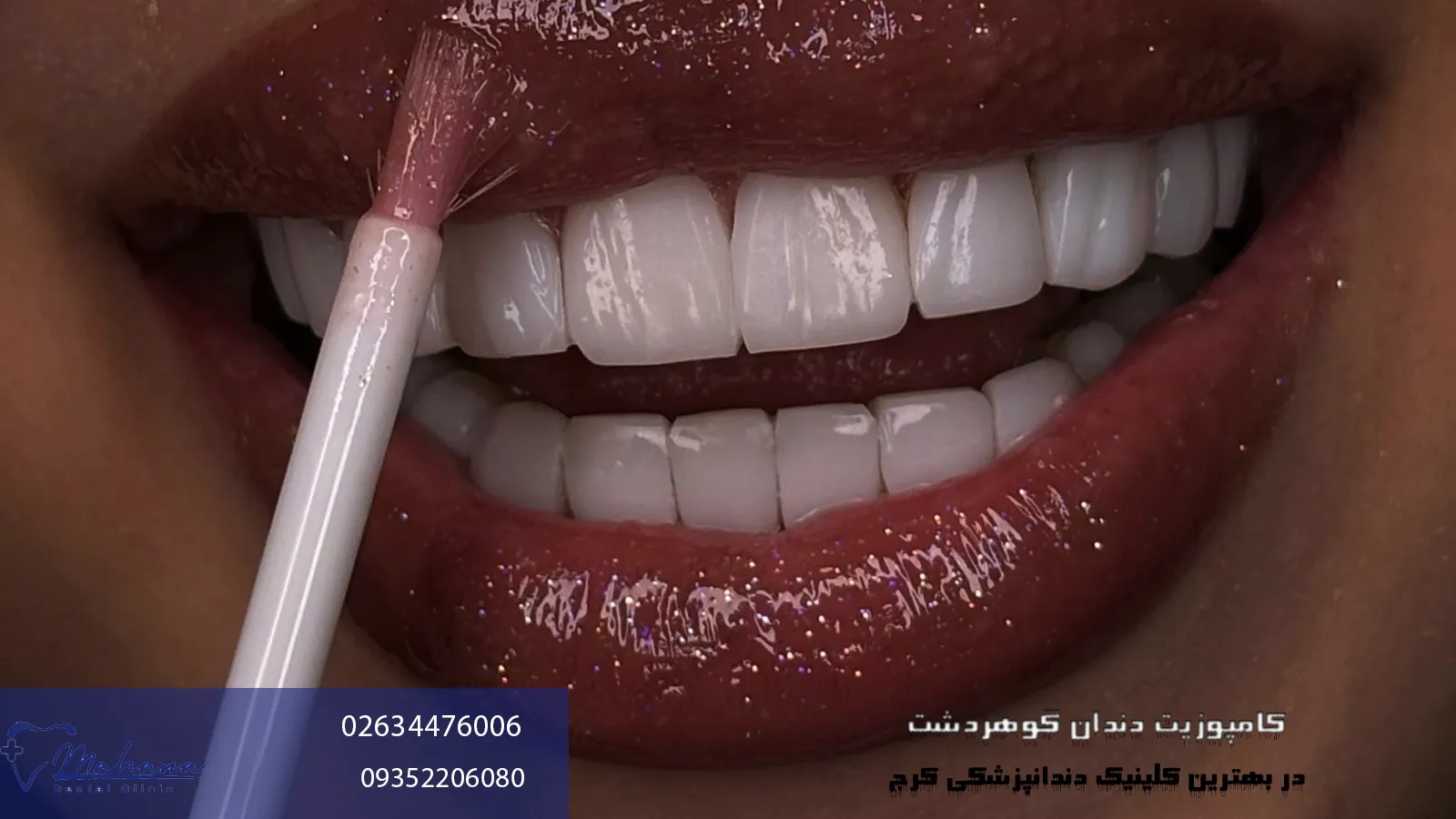 کامپوزیت دندان در گوهردشت