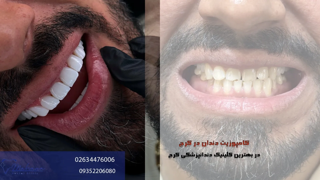 کامپوزیت دندان در کرج