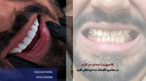 کامپوزیت دندان در کرج