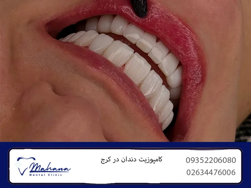 کامپوزیت قسطی کرج 