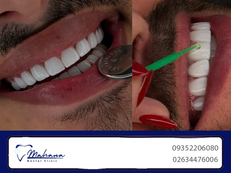 کامپوزیت در عظیمیه کرج 