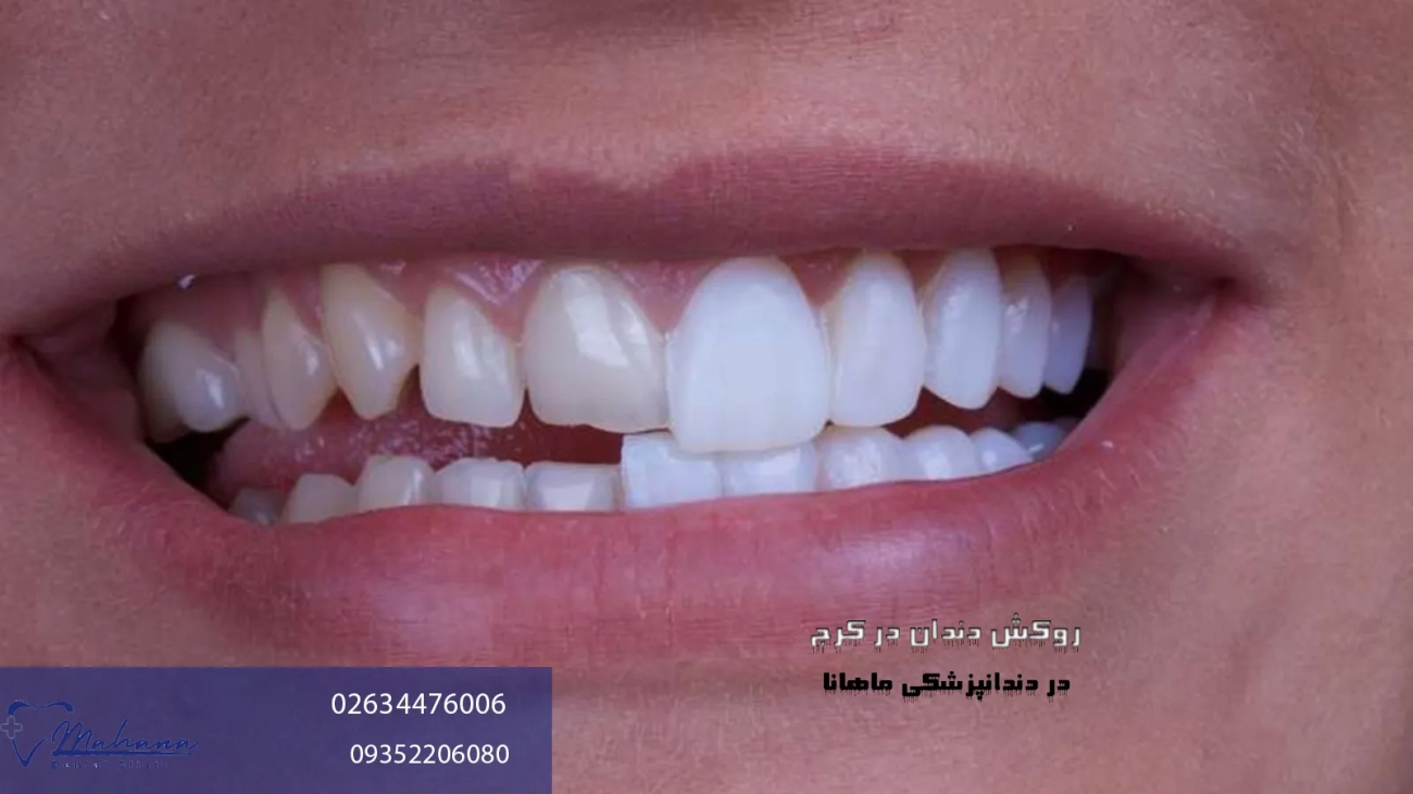 روکش دندان در کرج