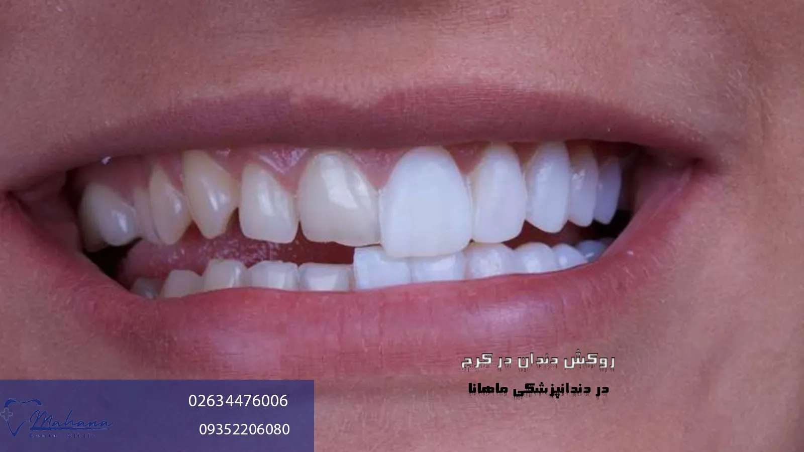 روکش دندان در کرج