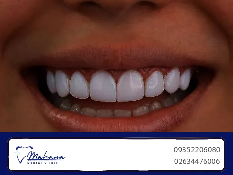 روکش دندان در گوهردشت