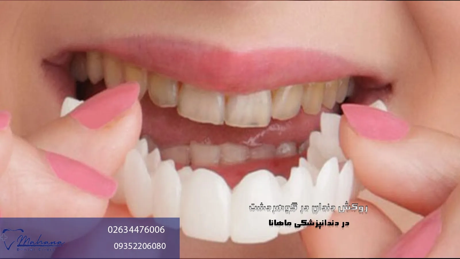 روکش دندان در عظیمیه کرج