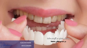 روکش دندان در عظیمیه کرج