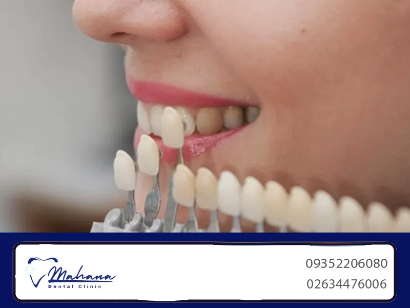 روکش دندان کرج