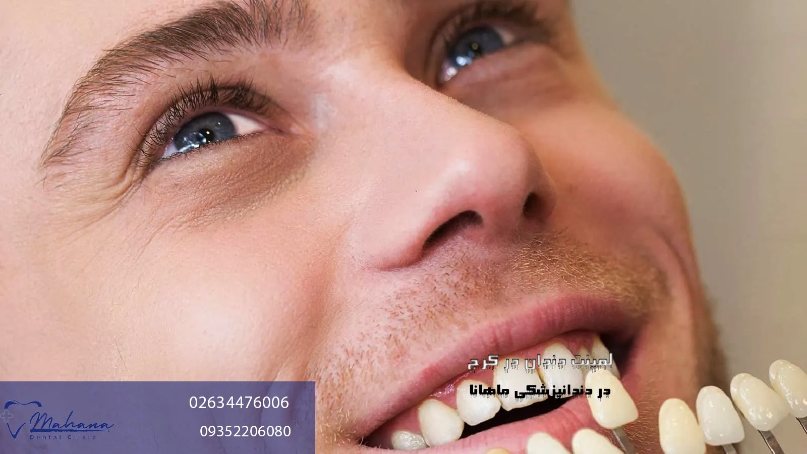 لمینت دندان در کرج