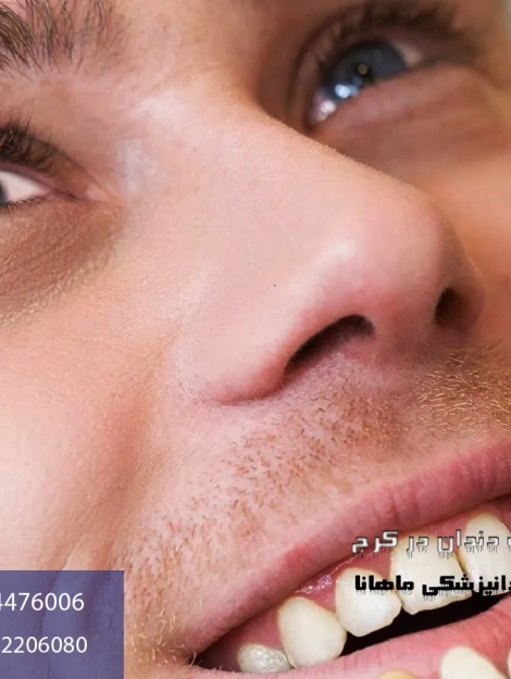 لمینت دندان در کرج