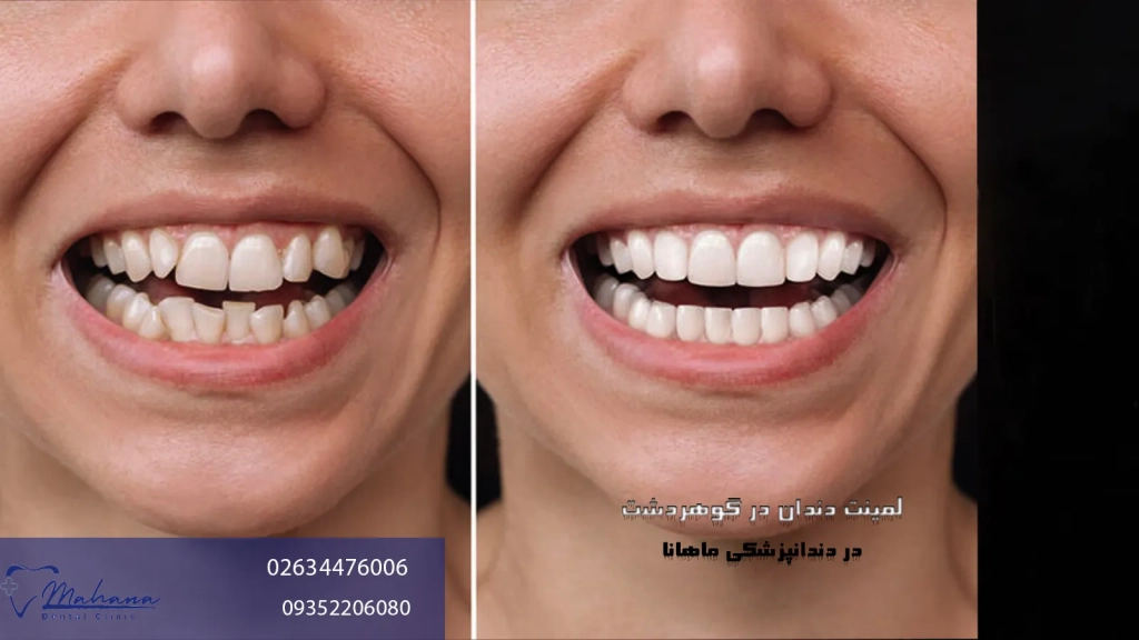 لمینت دندان در گوهردشت