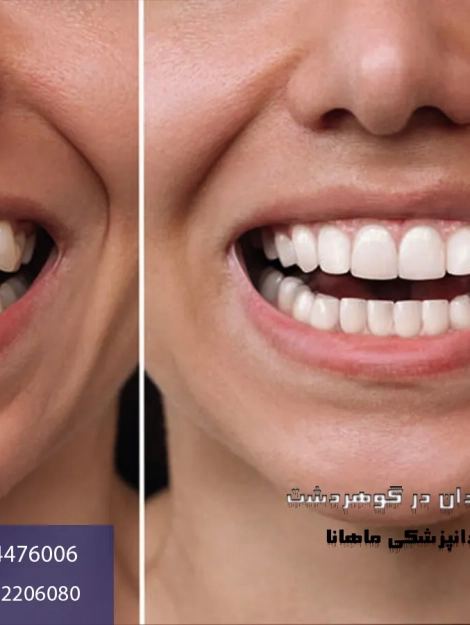 لمینت دندان در گوهردشت