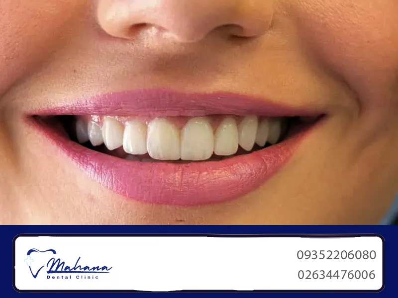 لمینت دندان در مهرشهر کرج