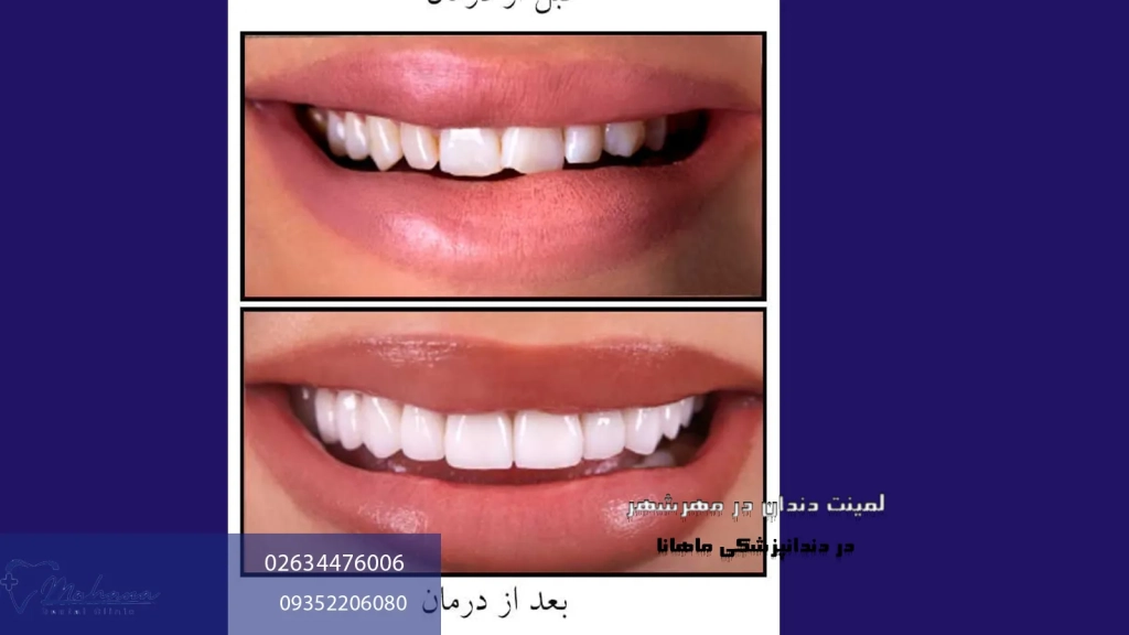 لمینت دندان در مهرشهر