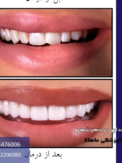 لمینت دندان در مهرشهر