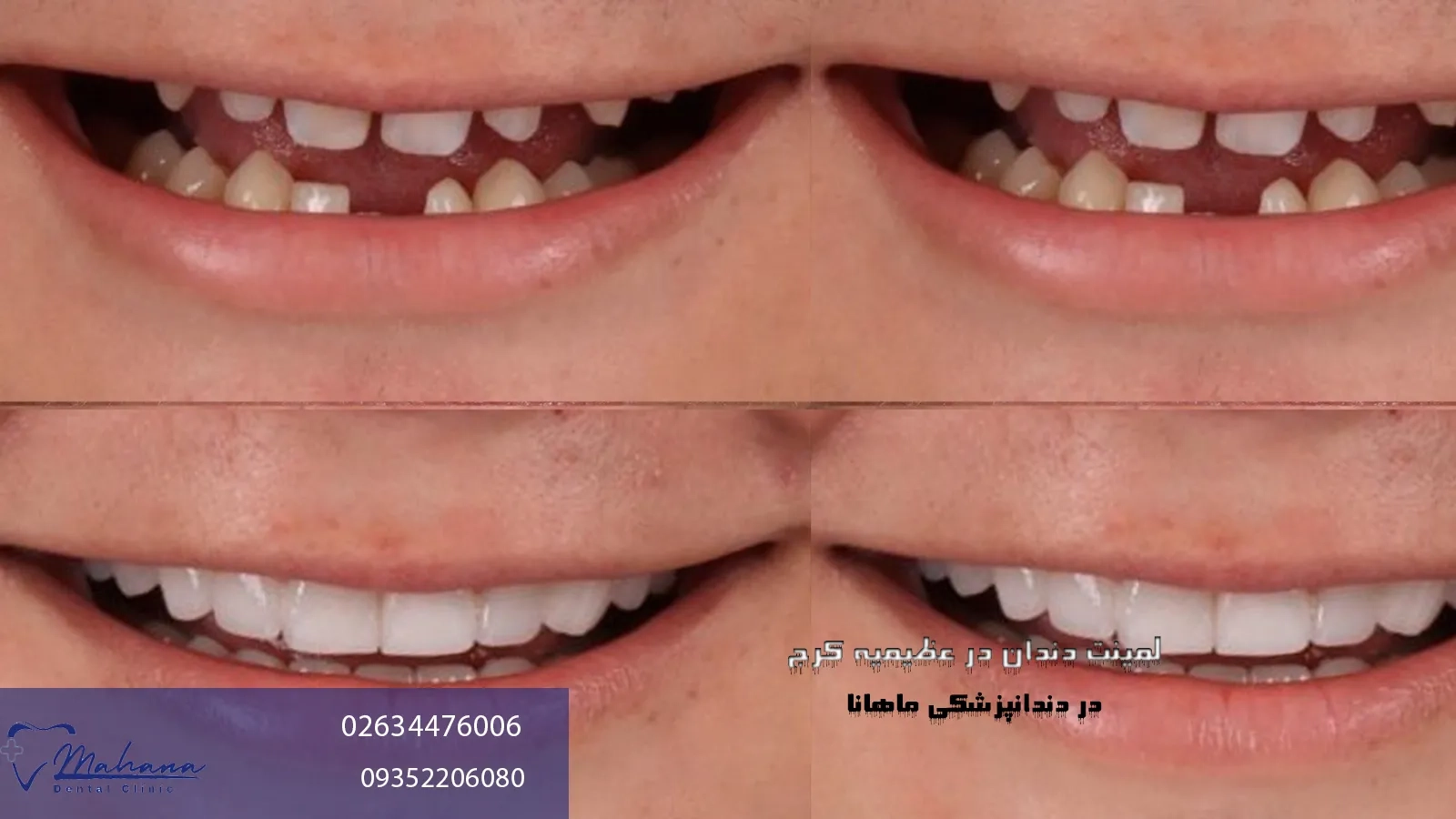 لمینت دندان در عظیمیه کرج