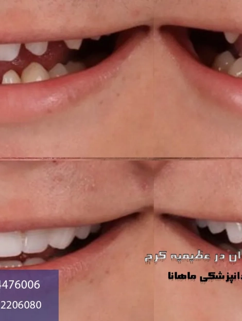 لمینت دندان در عظیمیه کرج