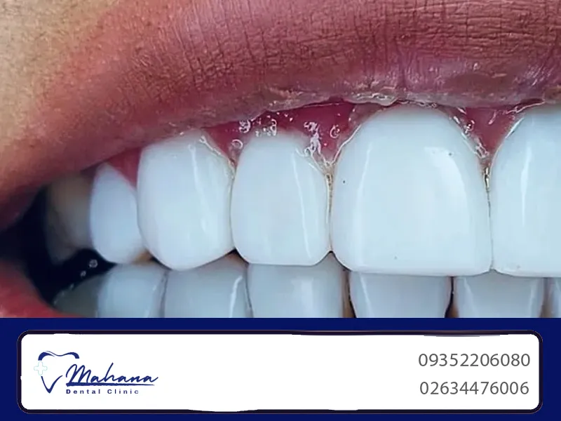 لمینت دندان در کرج