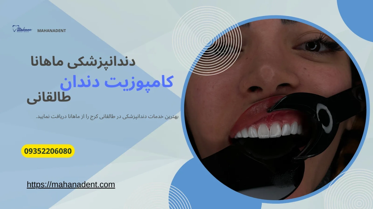 کامپوزیت دندان در طالقانی