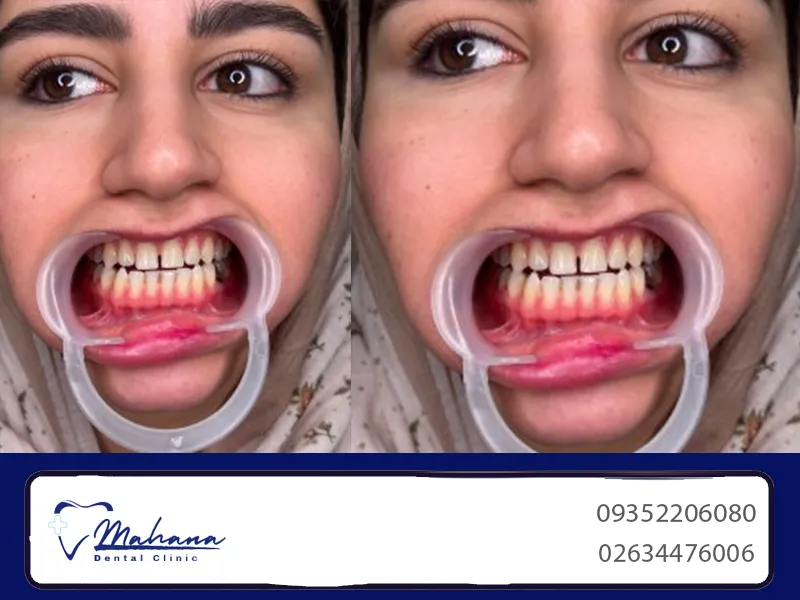 کامپوزیت در طالقانی کرج