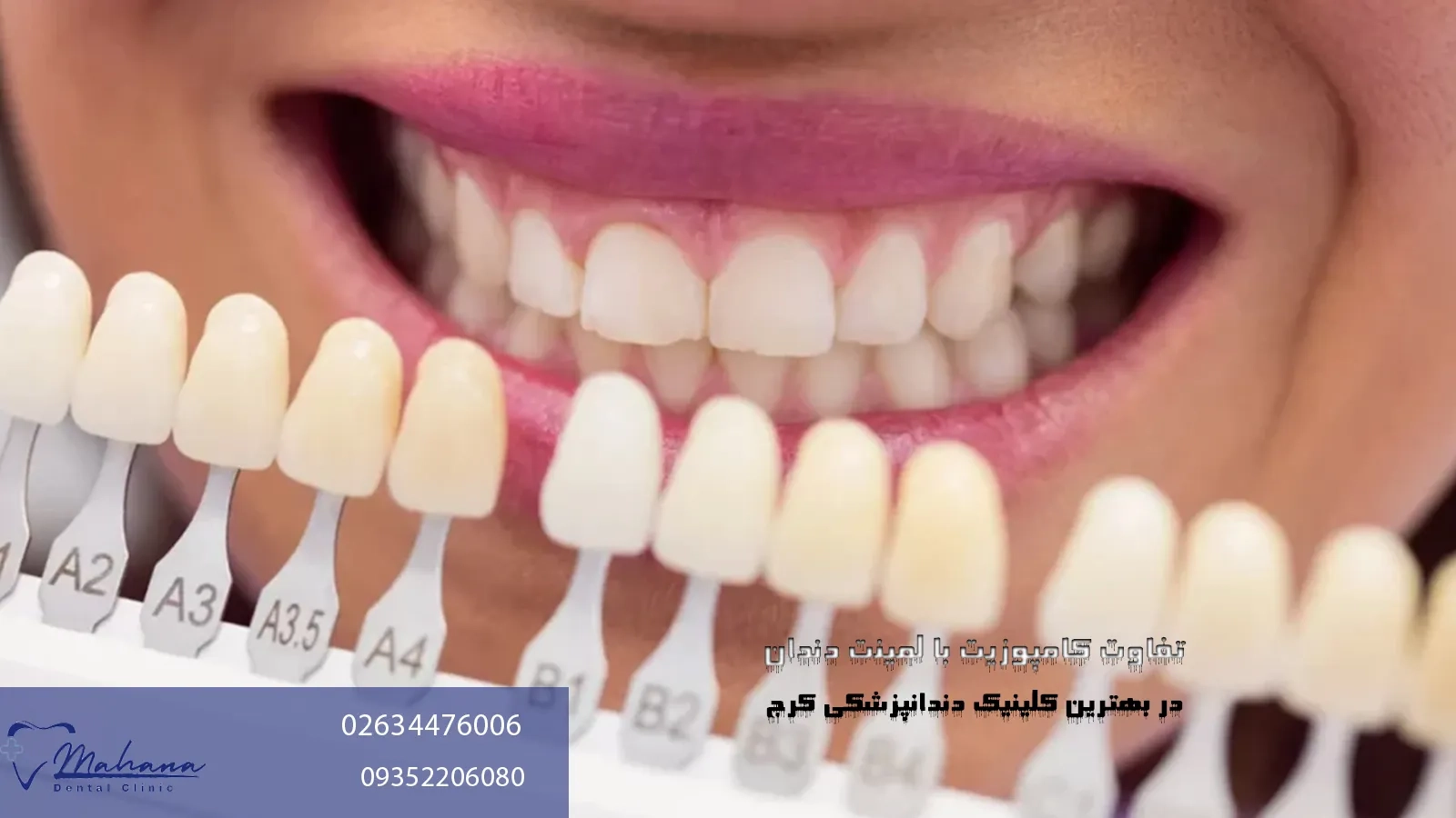 تفاوت لمینت با کامپوزیت