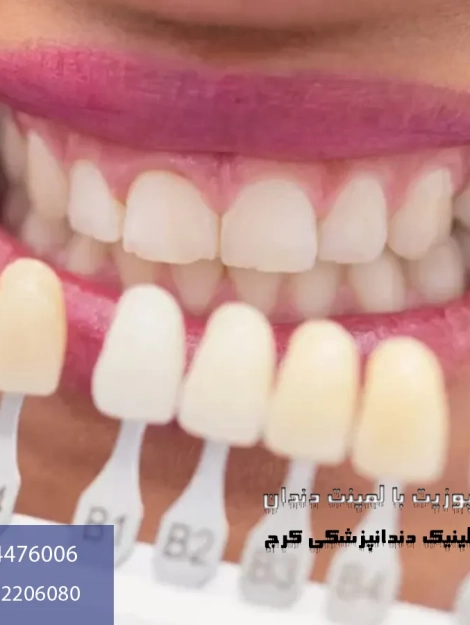 تفاوت لمینت با کامپوزیت