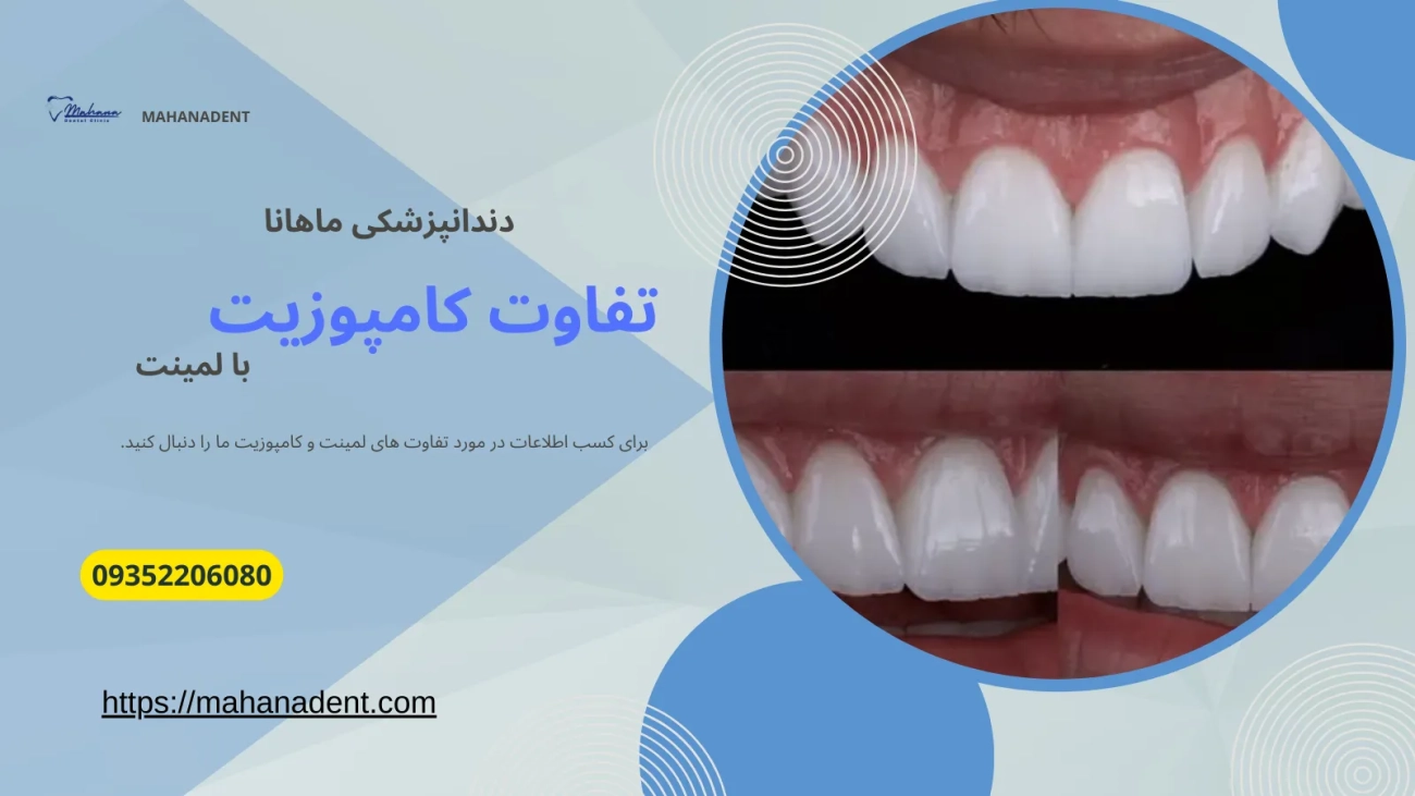 تفاوت کامپوزیت با لمینت دندان