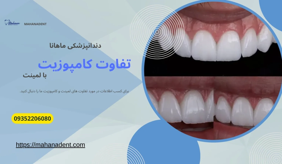 تفاوت کامپوزیت با لمینت دندان
