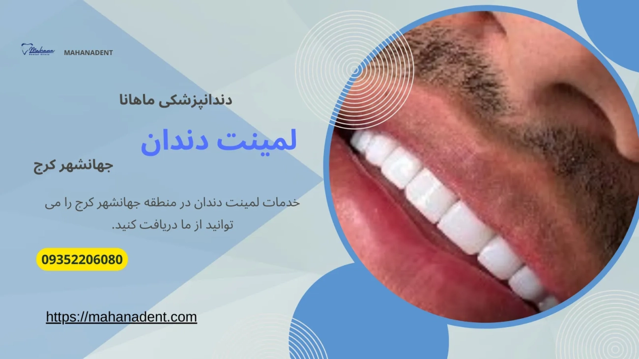 لمینت دندان در جهانشهر کرج