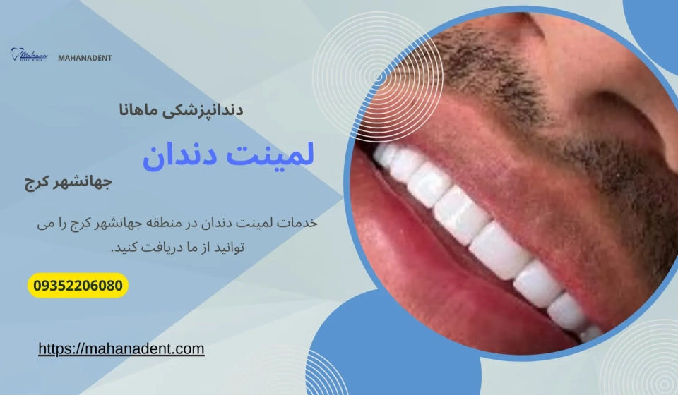 لمینت دندان در جهانشهر کرج